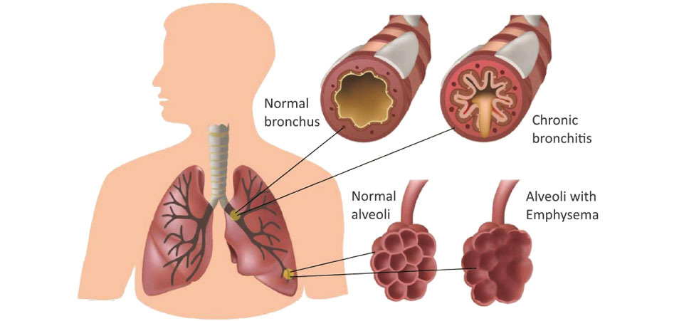 ابلاغ مسیربندی بالینی COPD