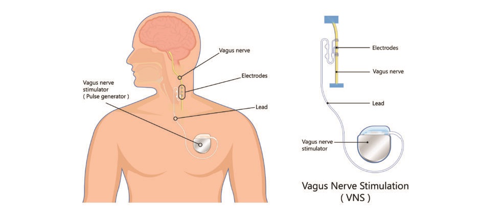 ابلاغ شناسنامه و استاندارد خدمت (Vagal Nerve Stimulation (VNS (نسخه دوم)‎