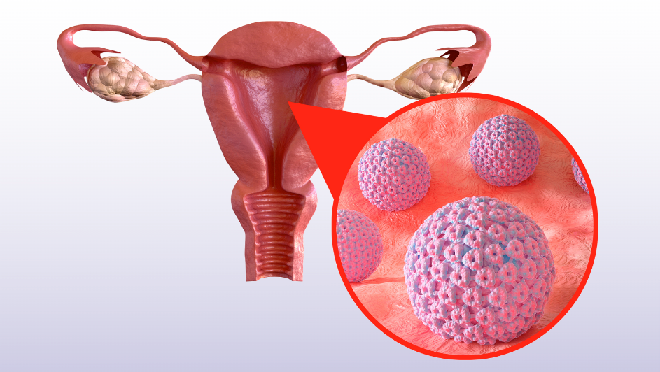سمینار تازه های hpv